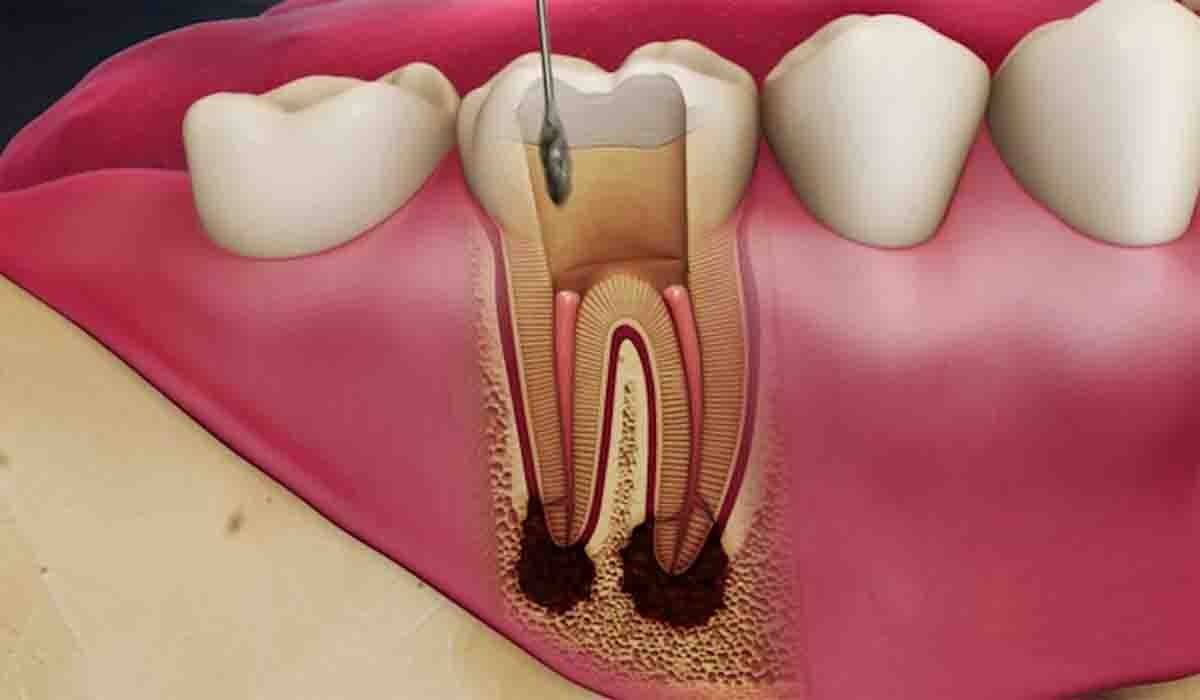 درمان ریشه دندان اصفهان