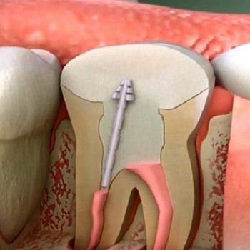 هدف از درمان ریشه دندان