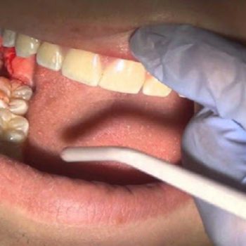 جراحی و EXT دندان