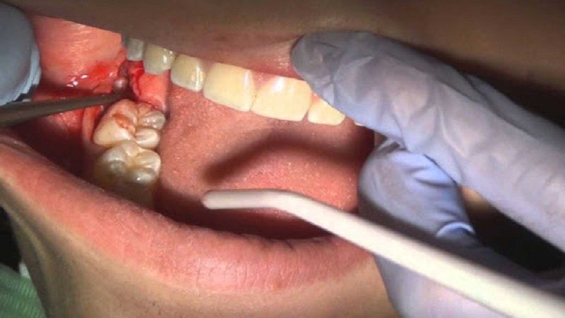جراحی و EXT دندان