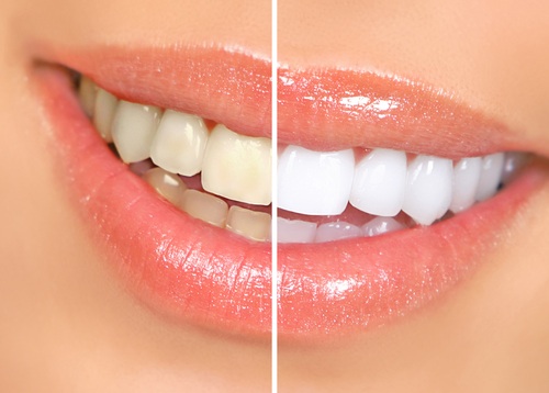 سفید کردن دندان ها با فرآیند بلیچینگ