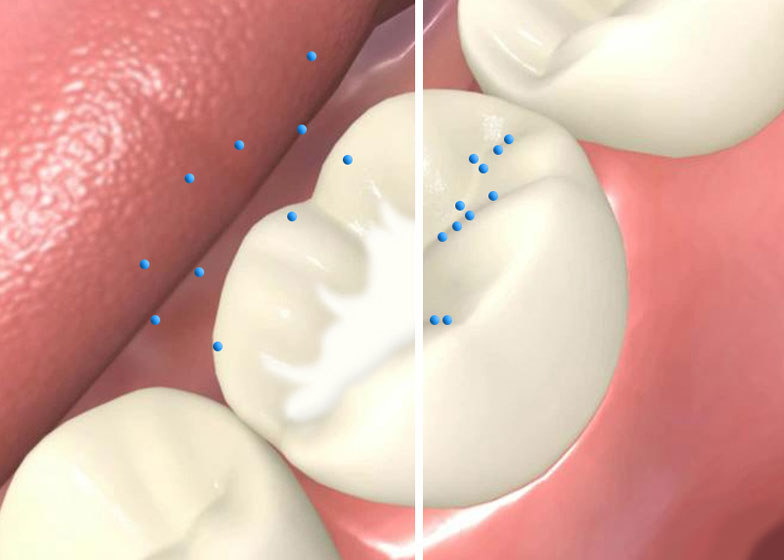 شیاربندی دندان با کمک سیلانت دندانپزشکی