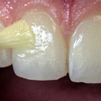 جرم گیری فلورایدتراپی دندان