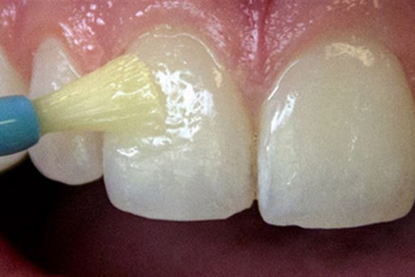 جرم گیری فلورایدتراپی دندان