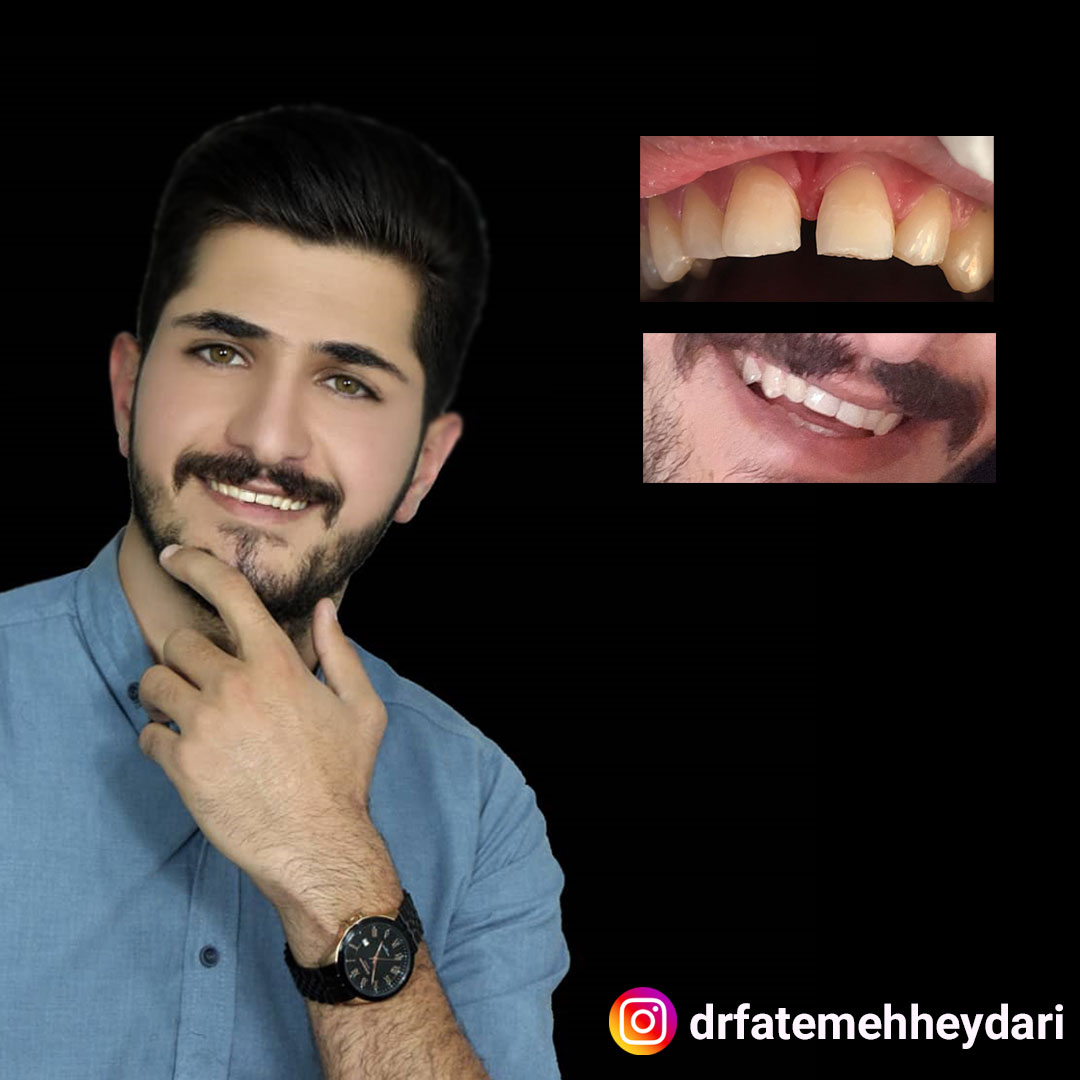 از بین بردن فاصله بین دندان ها