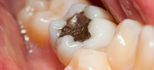 اهمیت پرکردن دندان چیست
