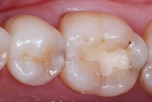 پرکردن دندان با مواد مختلف