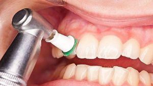 جرم گیری بهتری است یا ببیچینگ دندان ؟