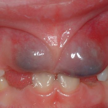 درمان سریع آبسه دندان کودکان