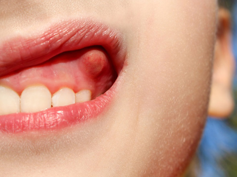 درمان سریع آبسه دندان کودکان