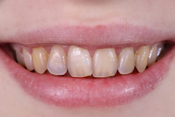دلایل تغییر رنگ دندان ها که باید بدانیم...