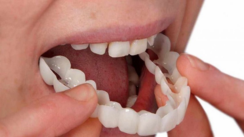 مزایا و معایب روکش دندان