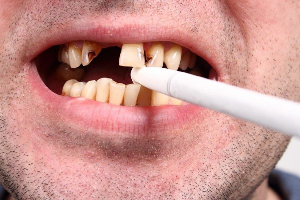 اثر دخانیات و سیگار بر سلامت دهان و دندان