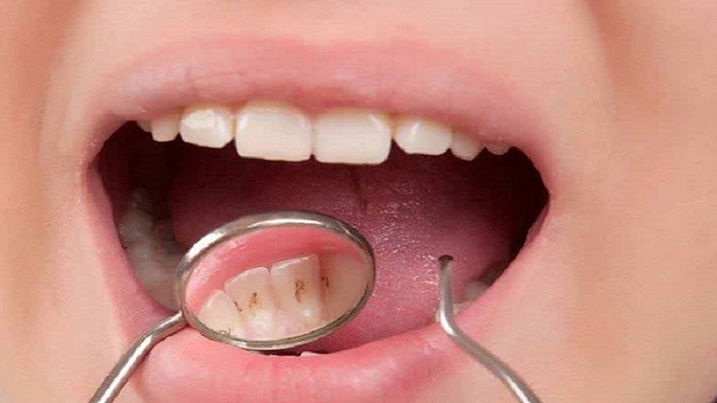جرمگیری دندان