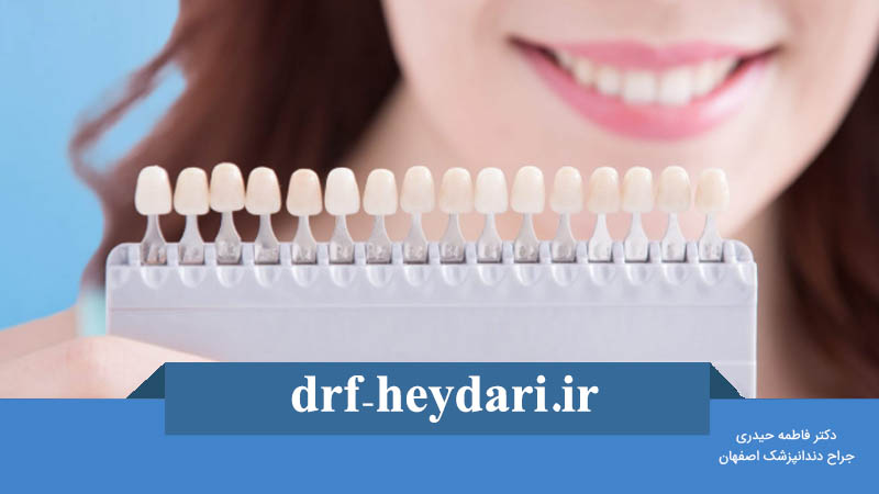 مراقبت بعد از لمینت دندان