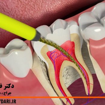 درمان ریشه دندان اصفهان