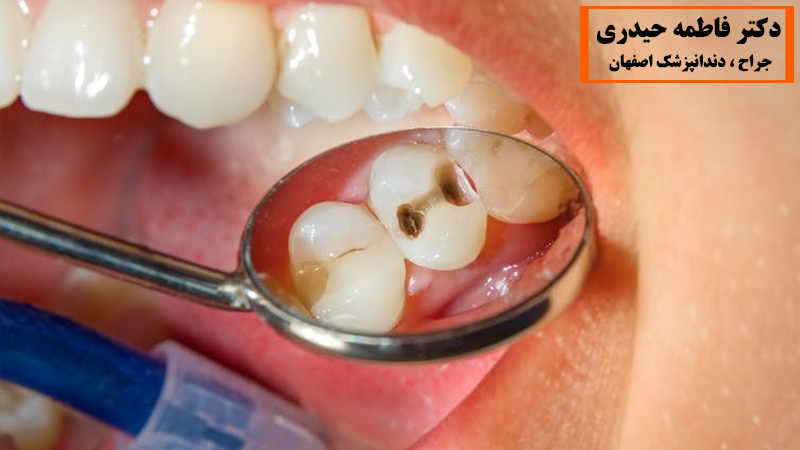درمان حفره های دندان