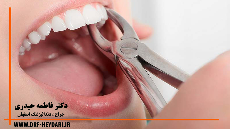 کشیدن دندان اصفهان
