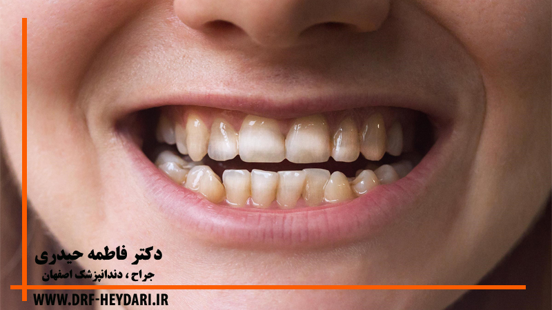 درمان لکه های قهوه ای روی دندان