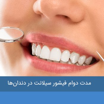  مدت دوام فیشور سیلانت در دندان‌ها