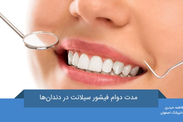  مدت دوام فیشور سیلانت در دندان‌ها