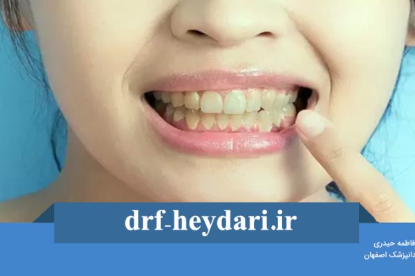 درمان خانگی زردی دندان