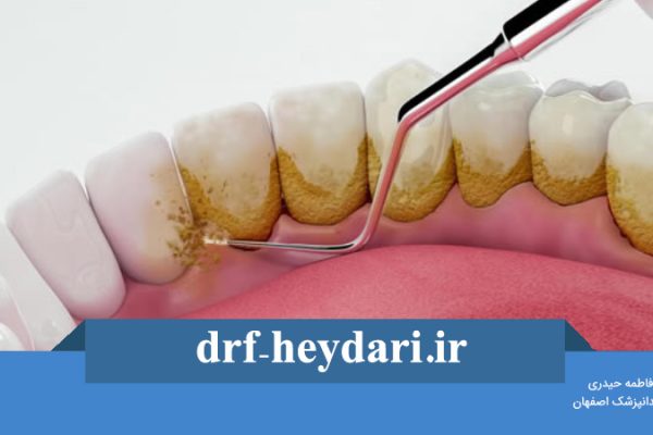 روش های جرمگیری دندان