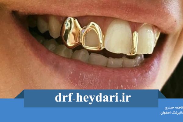 هزینه روکش طلا دندان