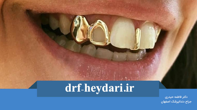 هزینه روکش طلا دندان