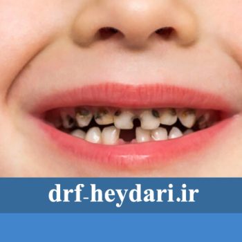 کشیدن دندان پوسیده کودکان