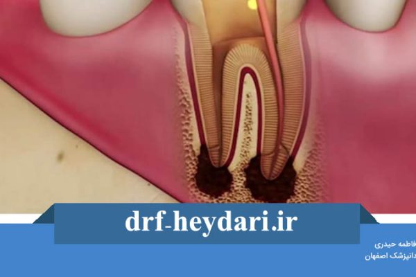 کشیدن ریشه دندان عفونی