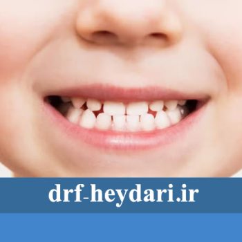 روش های کاشت دندان جلو کودکان