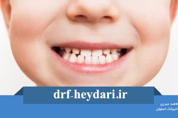 روش های کاشت دندان جلو کودکان