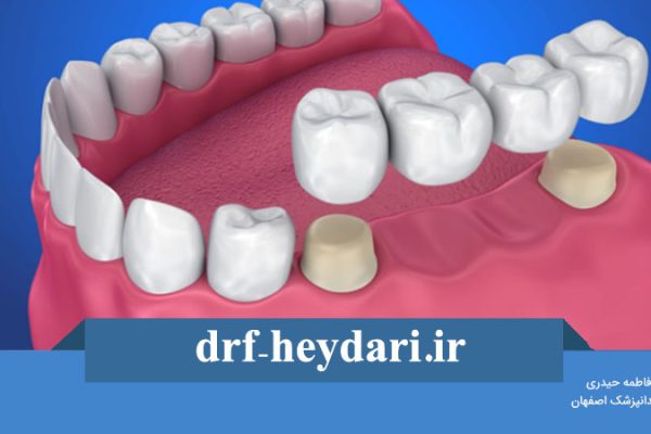 کاشت دندان به روش بریج برای کودکان