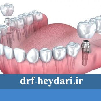 چند نوع کاشت دندان داریم