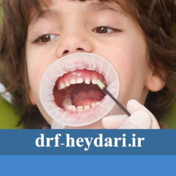 چسب روکش دندان کودکان