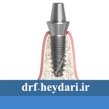 پیچ موقت ایمپلنت