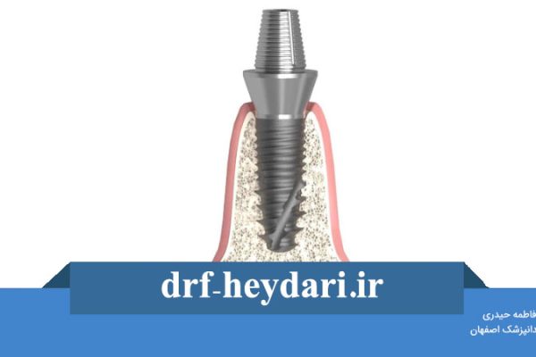 پیچ موقت ایمپلنت