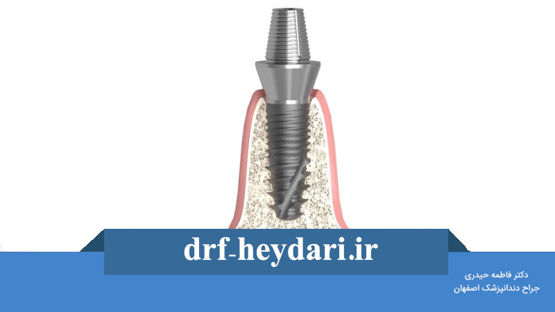 پیچ موقت ایمپلنت