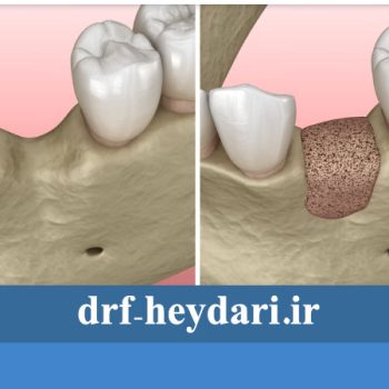 پیوند استخوان دندان