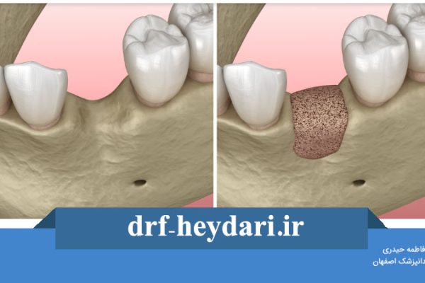 پیوند استخوان دندان