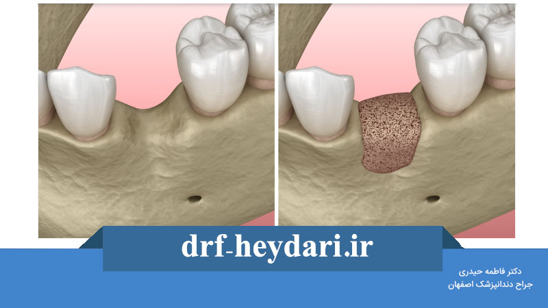پیوند استخوان دندان