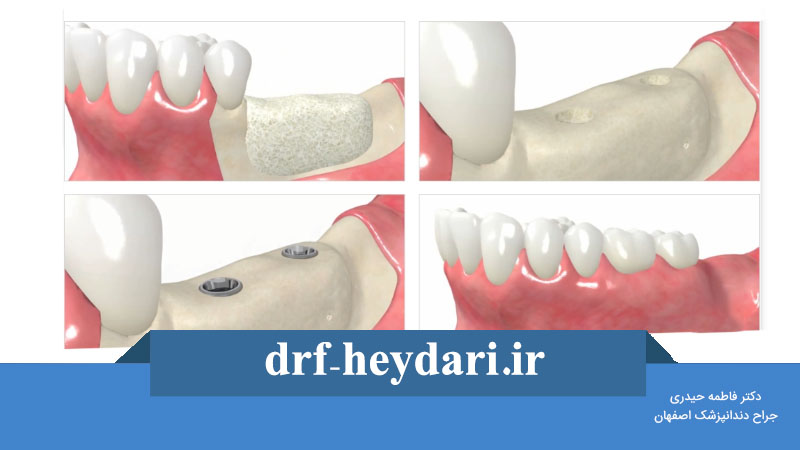 پیوند استخوان لگن به فک