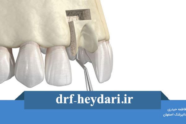 پیوند استخوان قبل از ایمپلنت