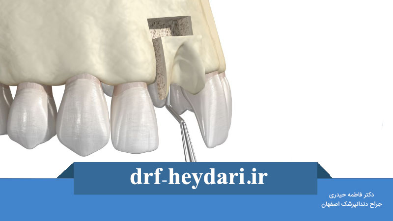 پیوند استخوان قبل از ایمپلنت