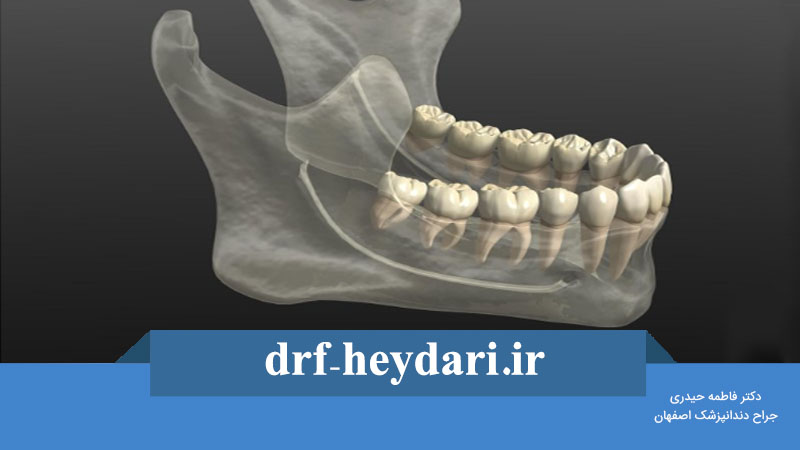 پیوند استخوان فک پایین