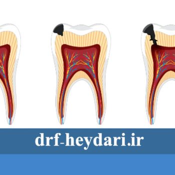 پوسیدگی سطحی دندان