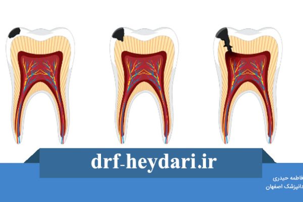 پوسیدگی سطحی دندان