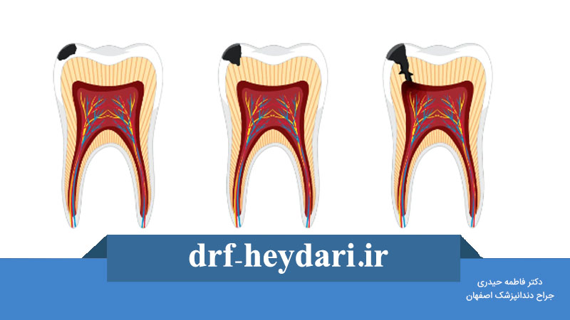 پوسیدگی سطحی دندان