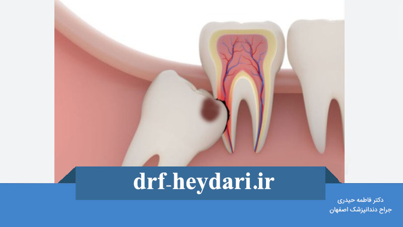 پوسیدگی دندان عقل